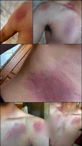 pictures of tortured body of a Palestinian after 10 days of detention by IDF occupation forces