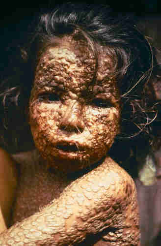 A child with smallpox in Bangladesh in 1973. The bumps filled with thick fluid and a depression or dimple in the center are characteristic. By Photo Credit:Content Providers(s): CDC/James Hicks - This media comes from the Centers for Disease Control and Prevention&#039;s Public Health Image Library (PHIL), with identification number #3265.Note: Not all PHIL images are public domain; be sure to check copyright status and credit authors and content providers.العربية | Deutsch | English | македонски | slovenščina | +/−, Public Domain, https://commons.wikimedia.org/w/index.php?curid=4394235