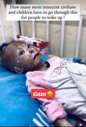 another victim of Israeli white phosphorus in Gaza